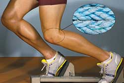 knee repair photo showing runner's knees